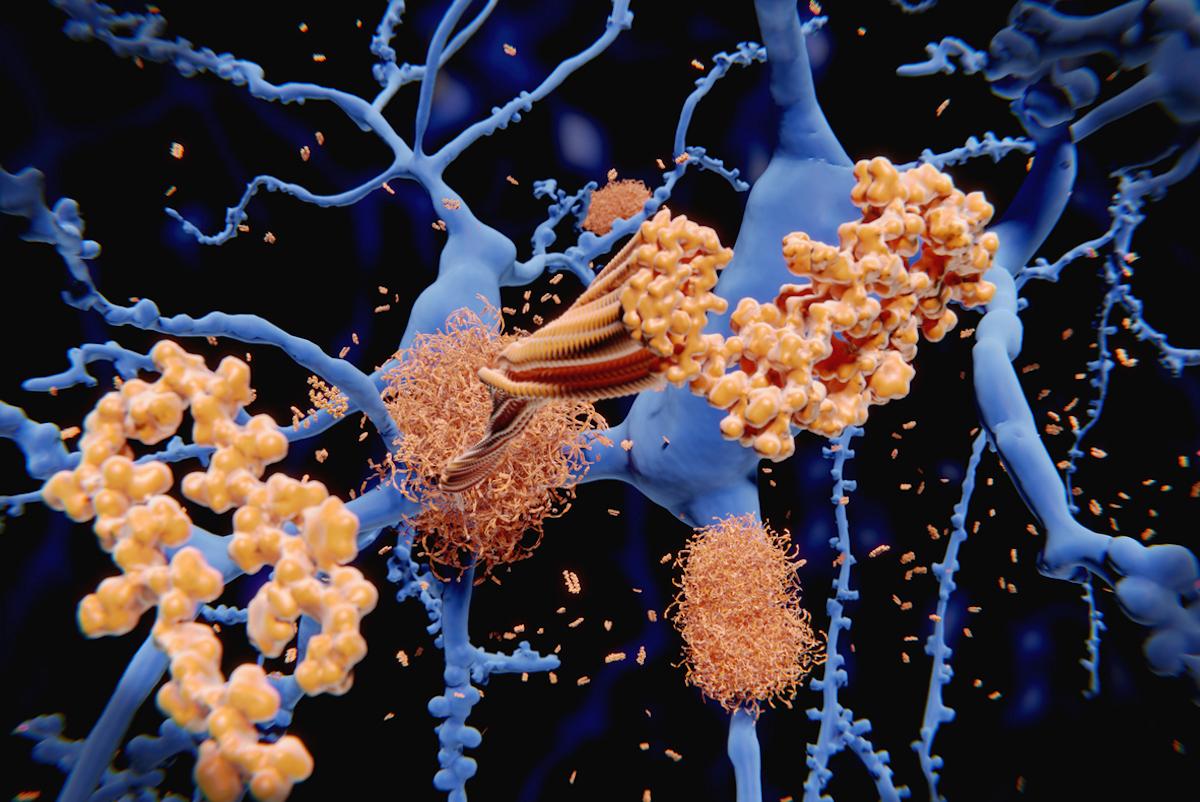 Alzheimer : des cas transmis témoignent de la possibilité d’une pathogénie prion-like