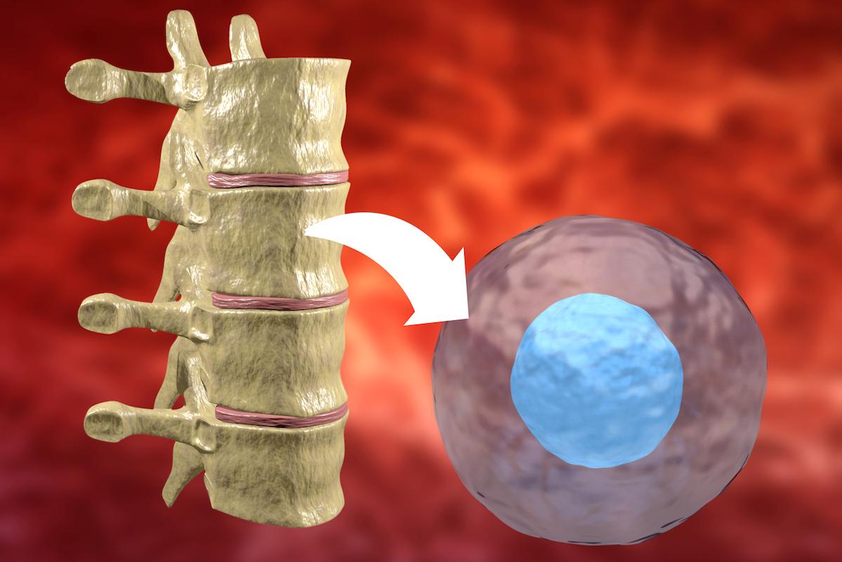 Lymphome à cellules du manteau : est-ce la fin de l’autogreffe en première ligne ?