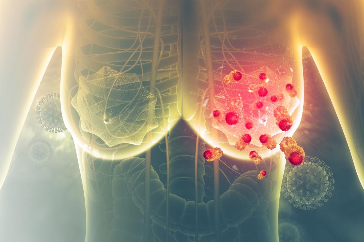 Cancer du Sein HER2+ : éribuline versus Taxanes