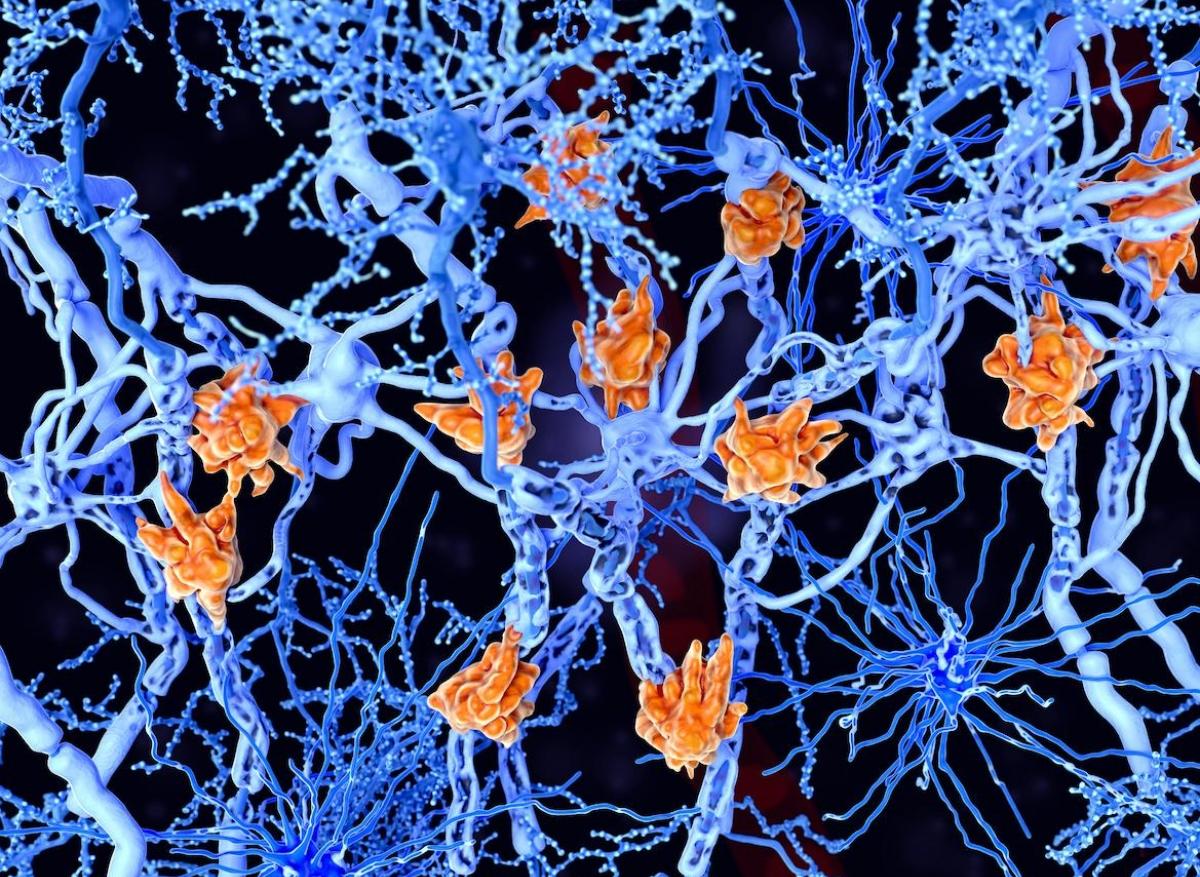 Sclérose en plaques : des signes neurologiques bien avant le diagnostic