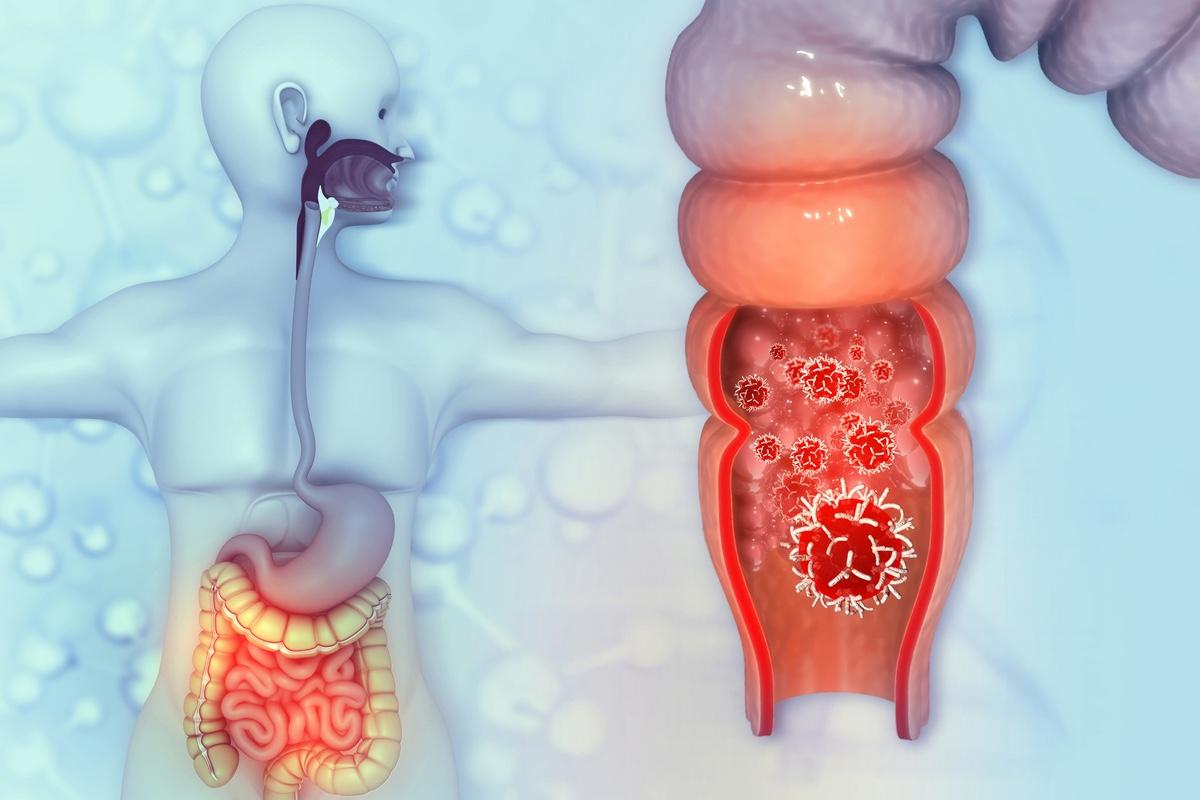 Cancer du rectum : l'essai TNTCRT confirme un bénéfice en survie sans maladie