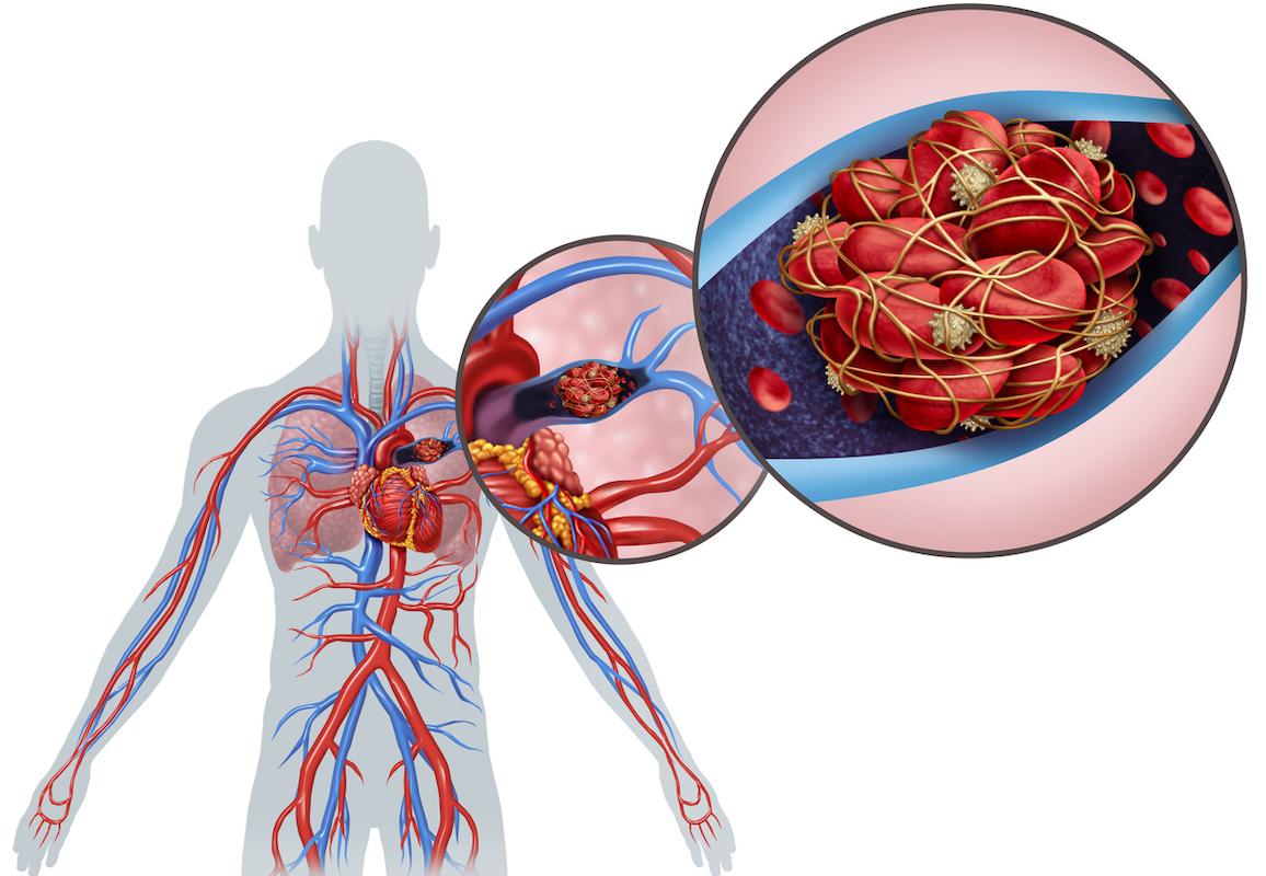 Maladie thromboembolique veineuse : les AOD à dose réduite sur le long cours