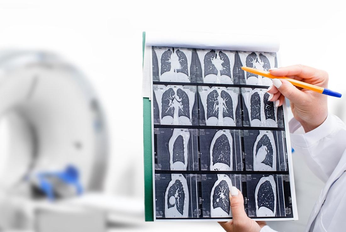 Cancer du poumon : perspectives sur son dépistage