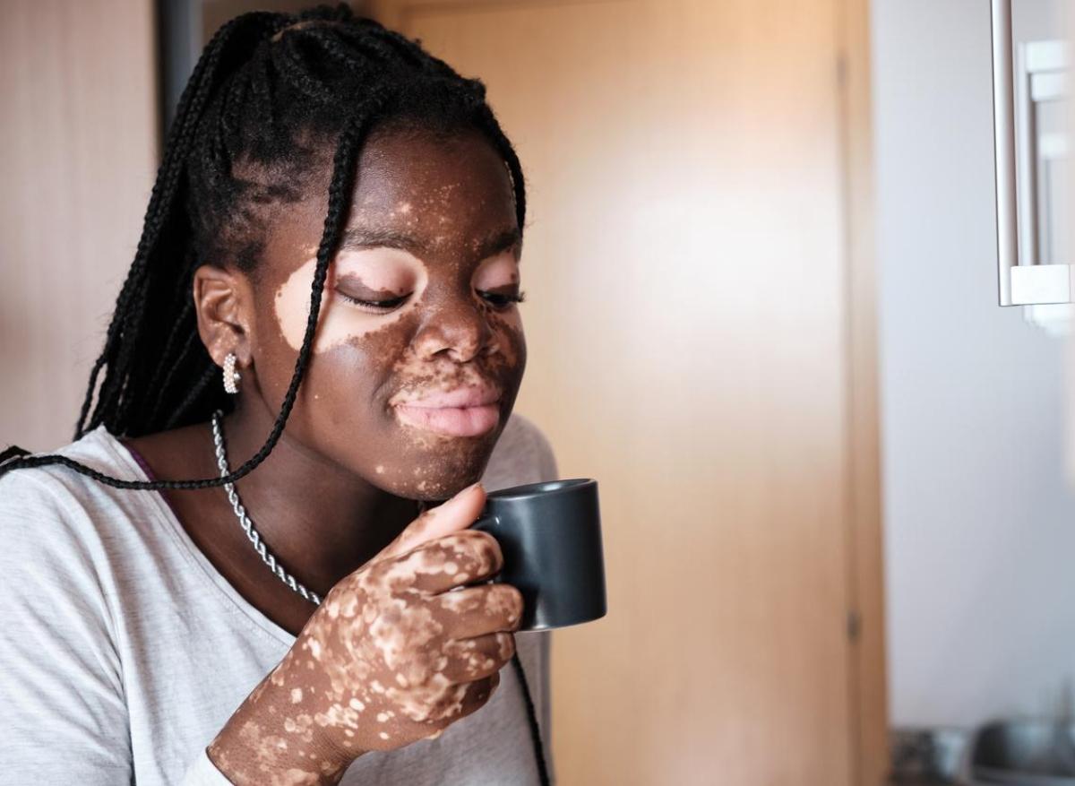 Vitiligo : le ruxolitinib en crème est disponible dans toutes les pharmacies