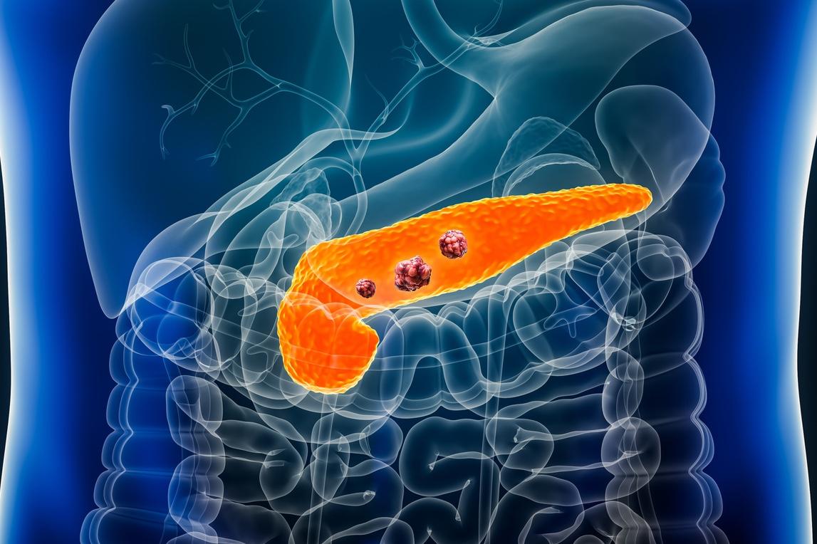 Adénocarcinome pancréatique oligométastatique : cibler les métastases en plus du traitement systémique