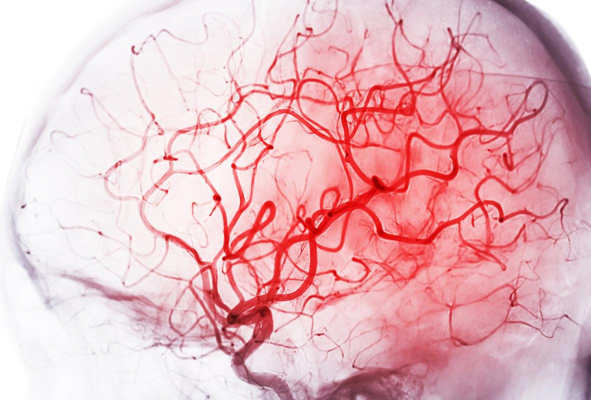 AIT ou AVC sur sténose intracrânienne : la dilatation sous-maximale serait bénéfique