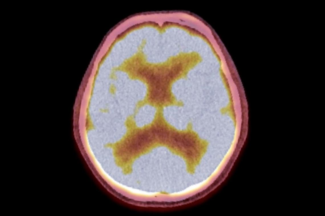 Cancer du sein : confirmation de l'efficacité intra-cérébrale du Trastuzumab / Deruxtecan