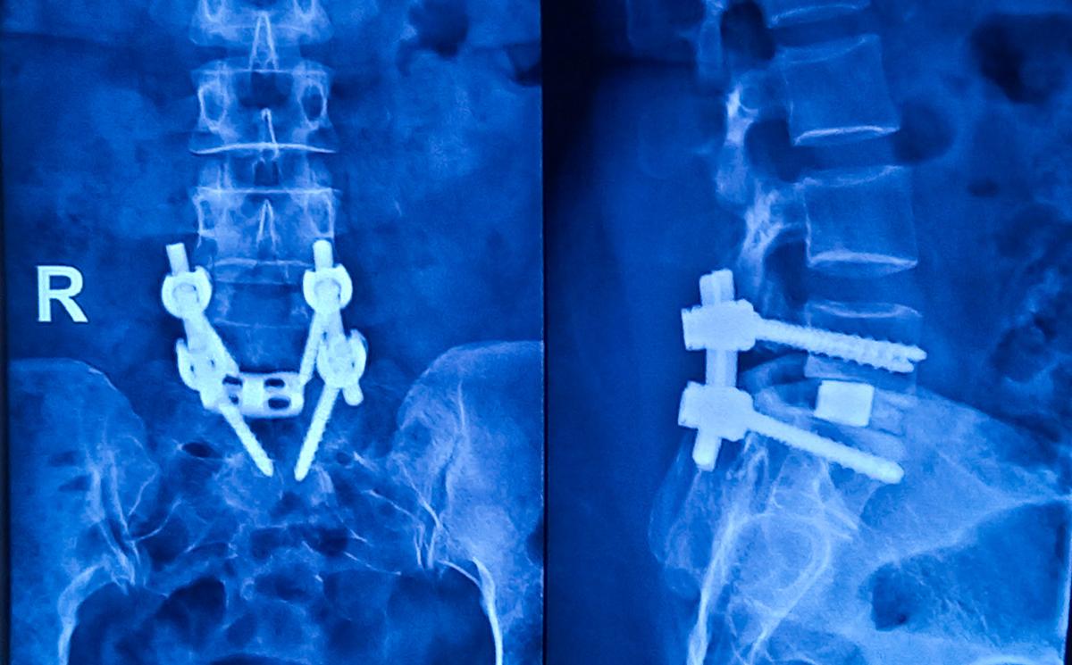 Spondylolisthésis lombaire dégénératif : à 5 ans la décompression seule est équivalente 