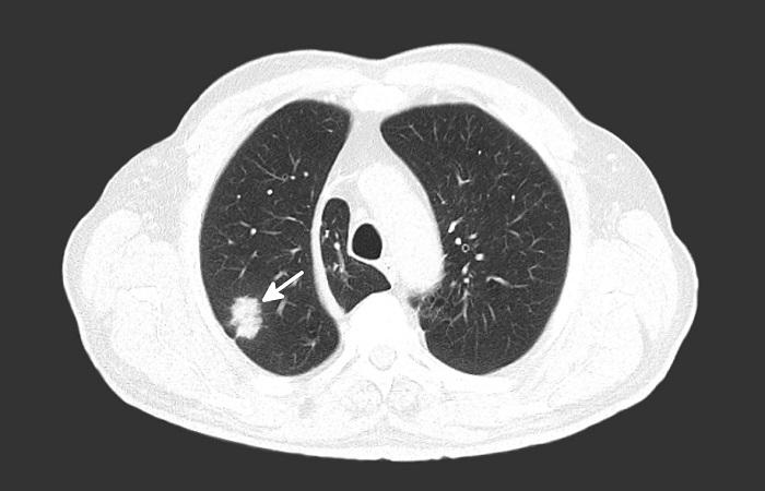 Cancer du poumon : prédiction de la malignité à partir du scanner et du tabagisme