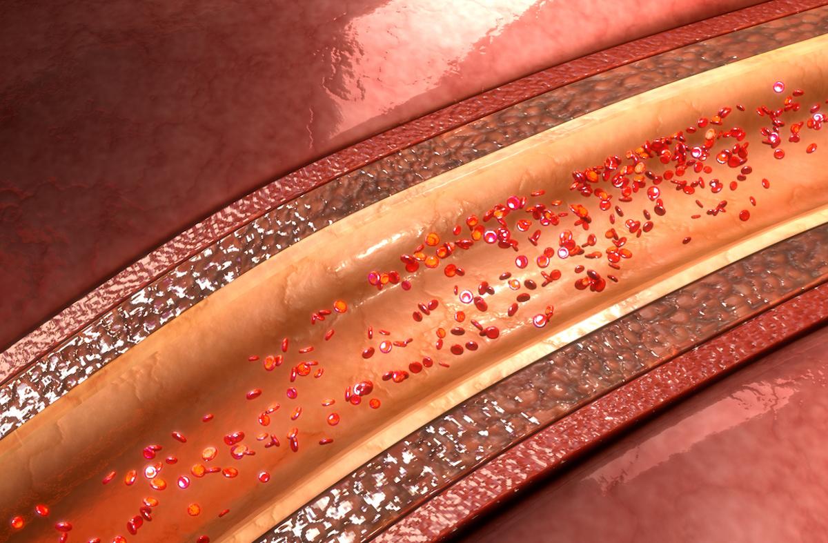 Risque cardiovasculaire : le score calcique permet d’optimiser la prévention primaire