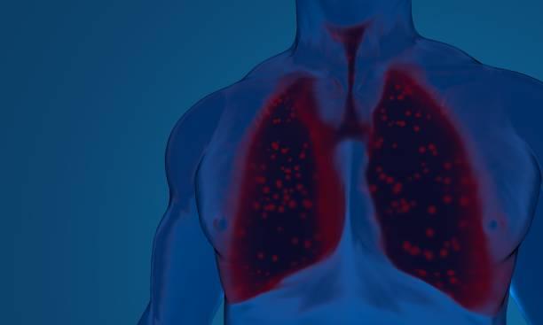 Pneumopathies interstitielles diffuses auto-immunes : guidelines américains sur des sujets attendus