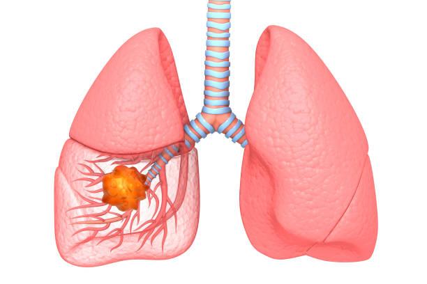 CBNPC résécables : intérêt du pembrolizumab en péri-opératoire