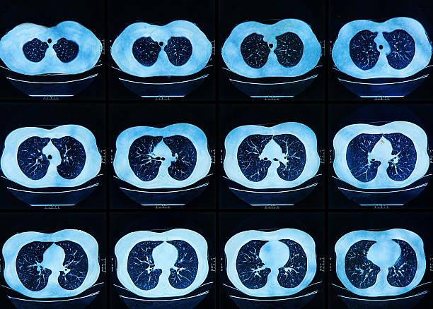 Profiter du scanner thoracique pour dépister les coronaropathies des patients BPCO